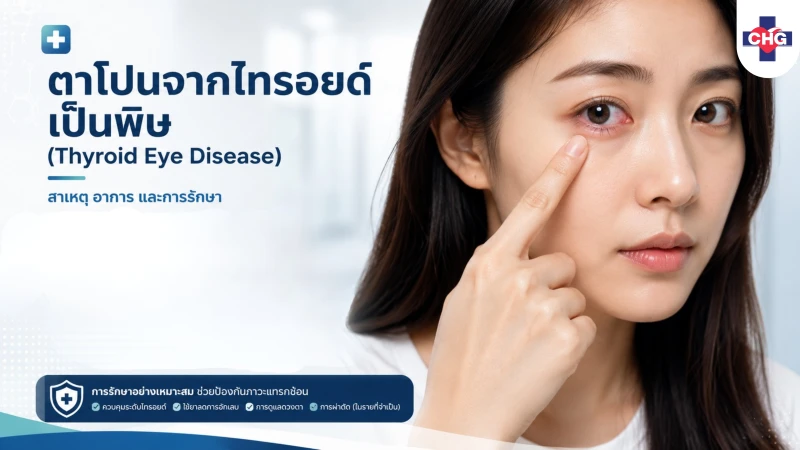 ตาโปนจากไทรอยด์เป็นพิษ (Thyroid Eye Disease): สาเหตุ อาการ และการรักษา