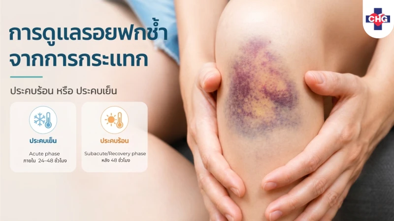 การดูแลรอยฟกช้ำจากการกระแทกควรประคบร้อนหรือประคบเย็น?
